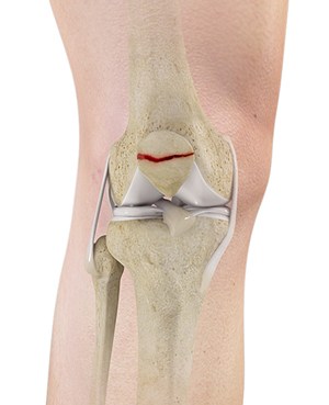 Knee fracture