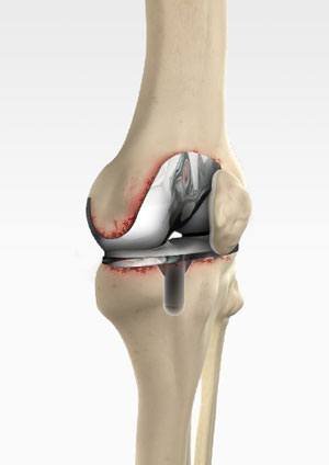 Knee Treatment Melbourne | Robotic Assisted Partial Knee Replacement