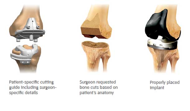 Patient-specific cutting guides