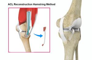 ACL Reconstruction Hamstring Tendo