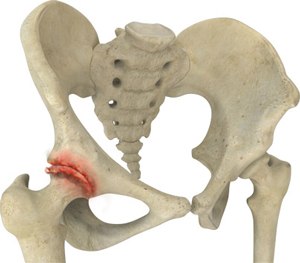 Inflammatory arthritis of the hip