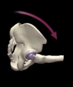 Optimised Total Hip Replacement