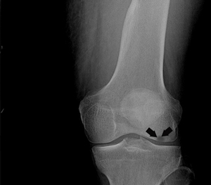 Osteonecrosis of the knee