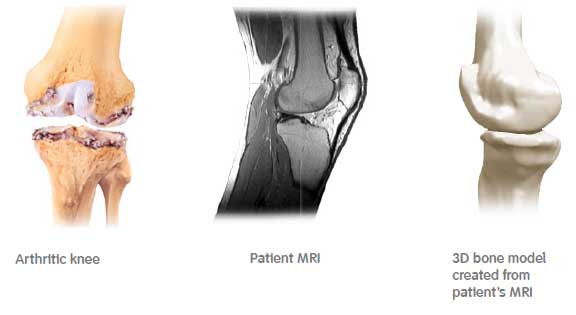 Patient-specific cutting guides